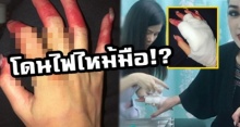 นักร้องดัง เผยภาพมือเสียโฉม! หลังจากโดนไฟไหม้มือ ต้องพันมือขึ้นเวที!