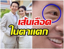 ขยี้ตาแรงเป็นเหตุ! อาร์ม พิพัฒน์ เส้นเลือดในตาขวาแตกเฉียบพลัน!