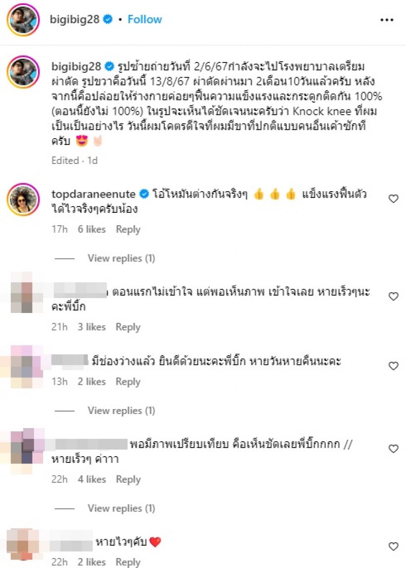 เปิดภาพเทียบชัดๆ นักแสดงหนุ่มดังคนนี้ มีขาที่ปกติแบบคนอื่นแล้ว