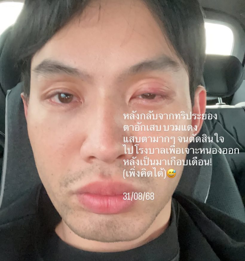 เตือนไม่ฟัง! มะตูม เจ็บหนัก หวั่นหายไม่ทันแคสงานที่เกาหลี