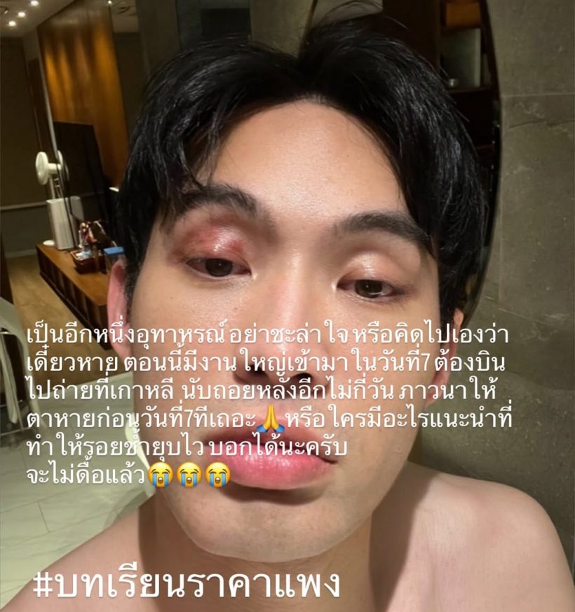 เตือนไม่ฟัง! มะตูม เจ็บหนัก หวั่นหายไม่ทันแคสงานที่เกาหลี
