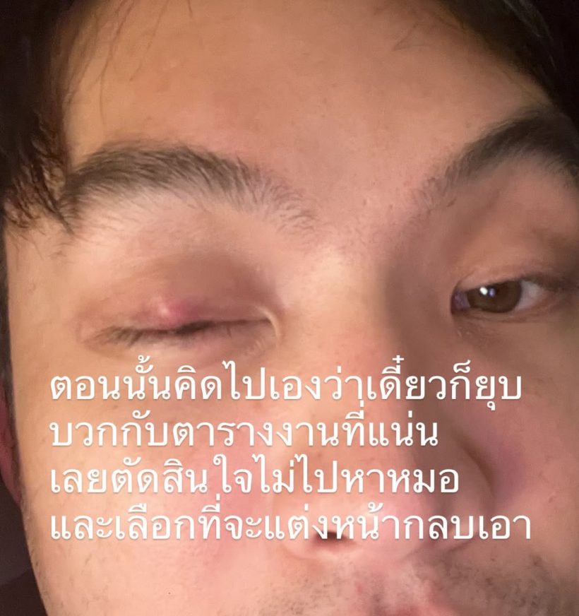 เตือนไม่ฟัง! มะตูม เจ็บหนัก หวั่นหายไม่ทันแคสงานที่เกาหลี