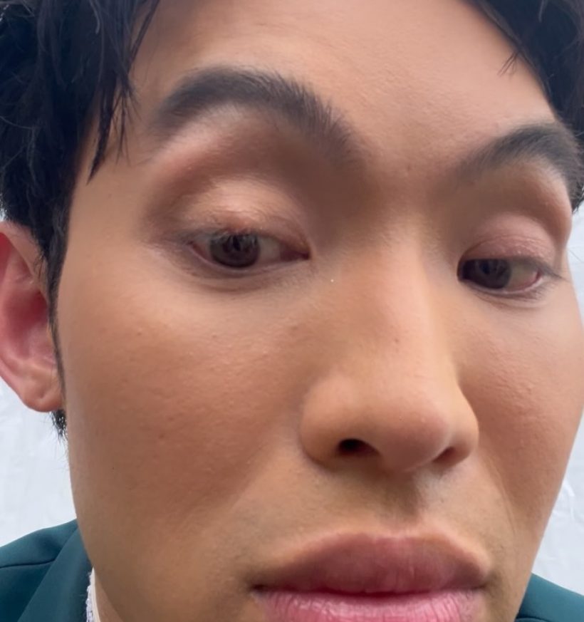 เตือนไม่ฟัง! มะตูม เจ็บหนัก หวั่นหายไม่ทันแคสงานที่เกาหลี