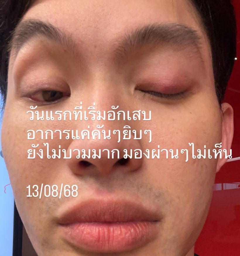 เตือนไม่ฟัง! มะตูม เจ็บหนัก หวั่นหายไม่ทันแคสงานที่เกาหลี