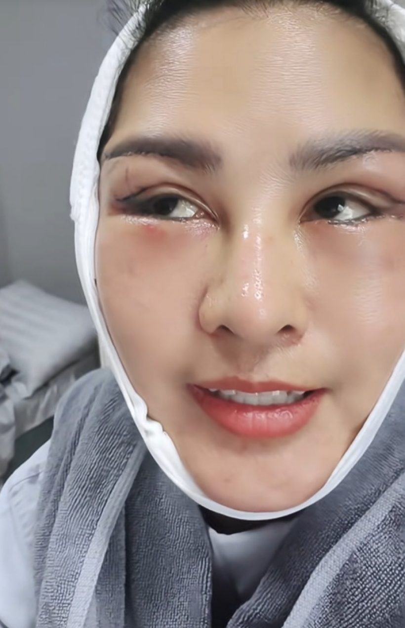 หน้าล่าสุด หญิงลี ศรีจุมพล หลังศัลยกรรม หน้าเด็กลงมาก