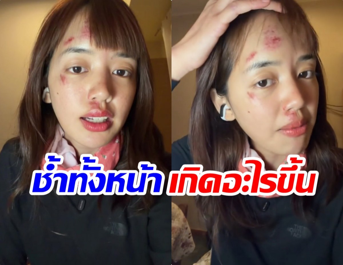 เเฟนๆห่วง พลอยไพลิน หน้าช้ำหลังกลับจากทริปแอนตาร์กติกา