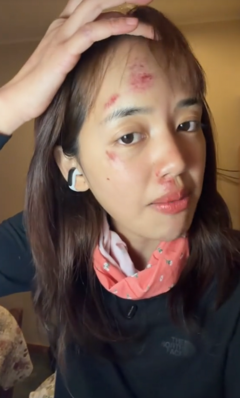 เเฟนๆห่วง พลอยไพลิน หน้าช้ำหลังกลับจากทริปแอนตาร์กติกา