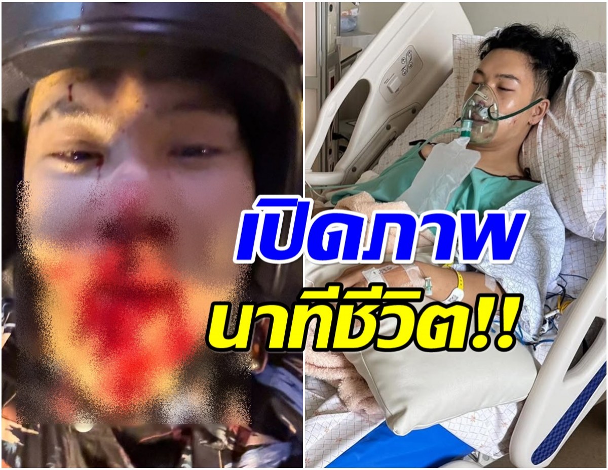 เปิดภาพนาทีชีวิต ตั้ม เดอะสตาร์ เลือดอาบ! หลังเกิดอุบัติเหตุใหญ่