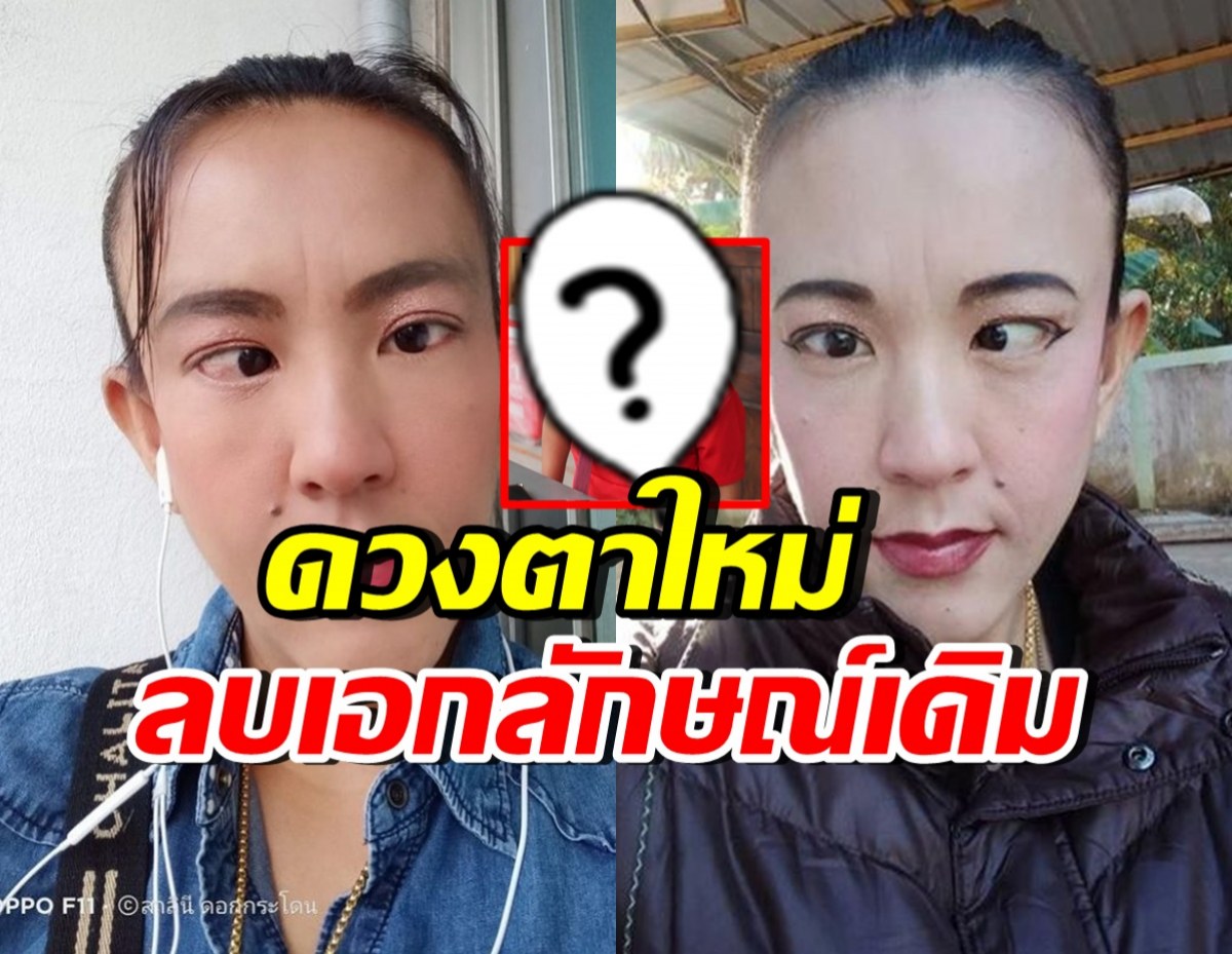 ภาพล่าสุดตลกดัง ตาหวาน ได้ดวงตาใหม่ แทบจำหน้าเดิมไม่ได้