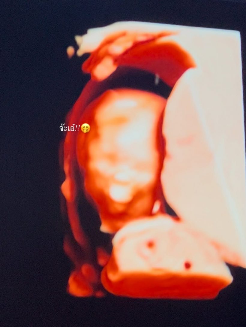 กรี๊ด! ดาราสาวดัง อวดภาพอัลตร้าซาวด์เบบี๋ ท้อง3เดือนแล้ว