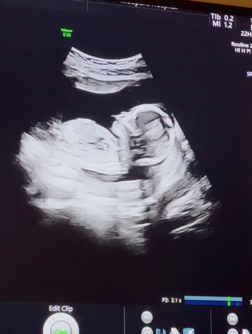 กรี๊ด! ดาราสาวดัง อวดภาพอัลตร้าซาวด์เบบี๋ ท้อง3เดือนแล้ว