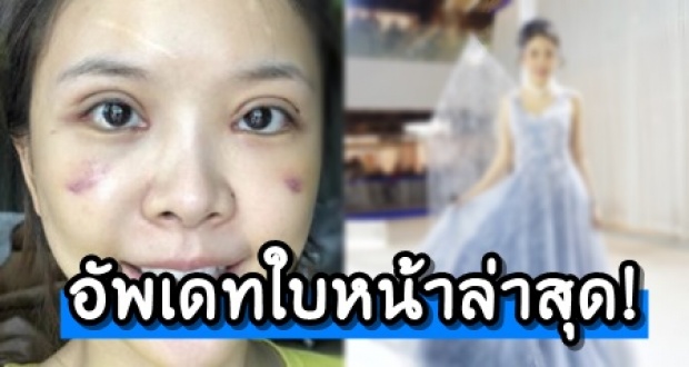 อัพเดทใบหน้าล่าสุด! “หญิงแย้ นนทพร” หลังศัลยกรรมมาเกือบเดือน!