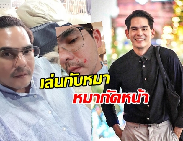 หวิดเสียโฉม! บิ๊ก ศรุต ถูกหมากัดหน้า! แผลลึกเลยทีเดียว โชคดีที่ไม่ต้องเย็บ  