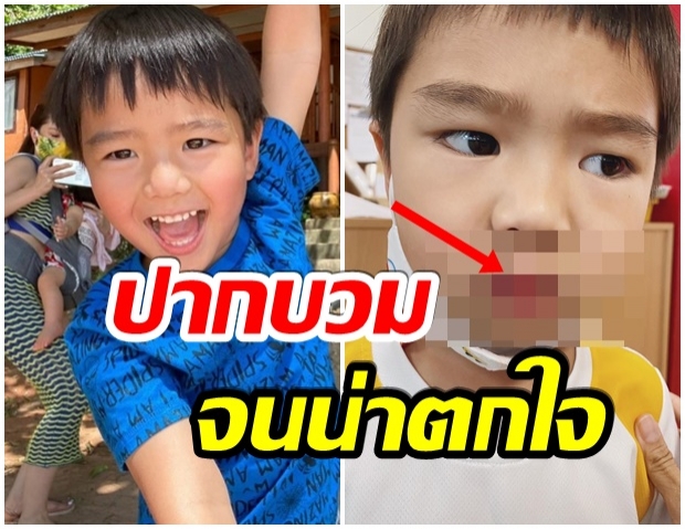 หวาดเสียว! ลิเดีย เล่าเหตุการณ์ น้องดีเเลน ปากบวมเจ่อ