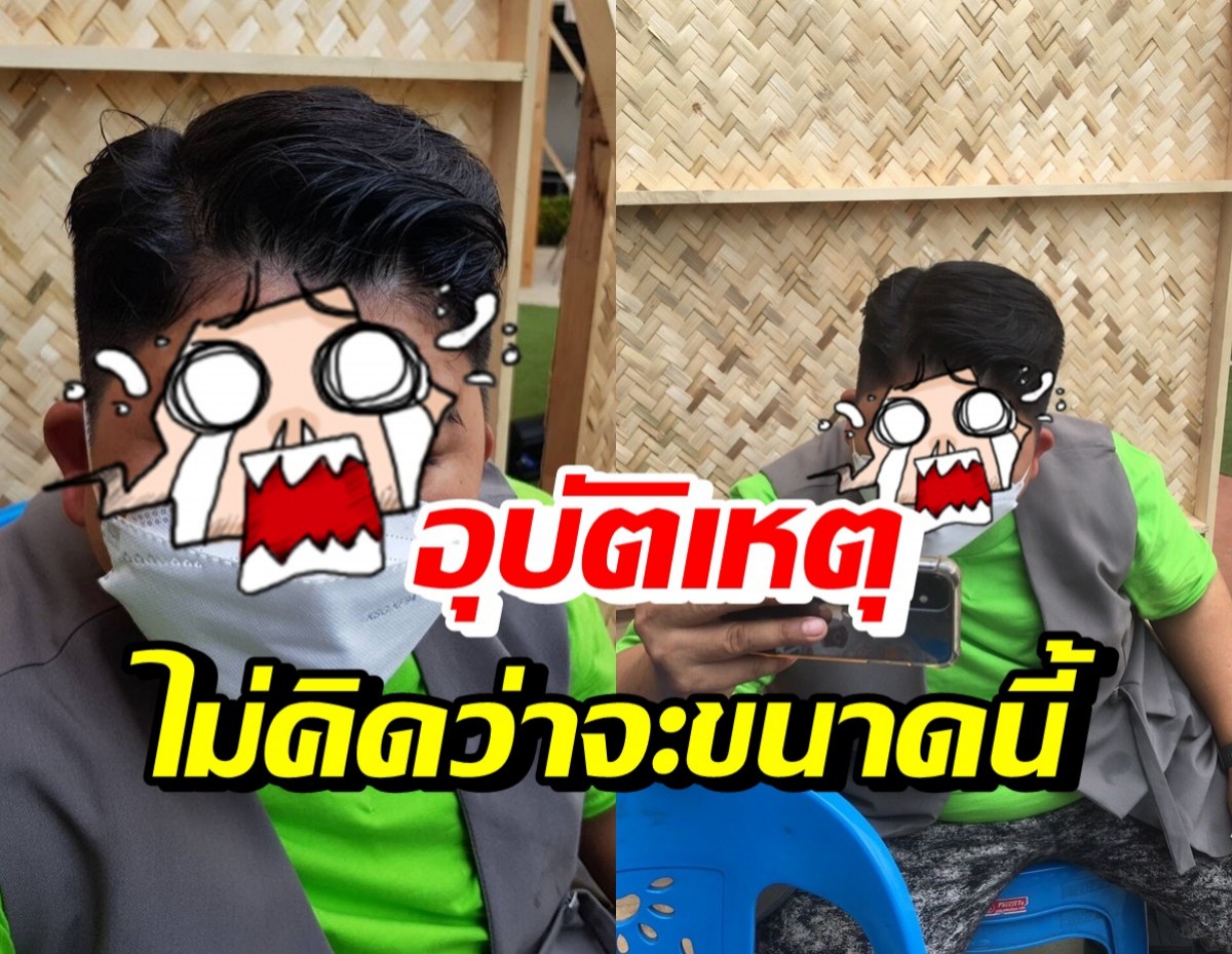 เปิดภาพสุดตกใจ โก๊ะตี๋ หน้าผากพุพองจากโดนฝาซึ้งร้อนๆ