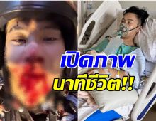 เปิดภาพนาทีชีวิต ตั้ม เดอะสตาร์ เลือดอาบ! หลังเกิดอุบัติเหตุใหญ่
