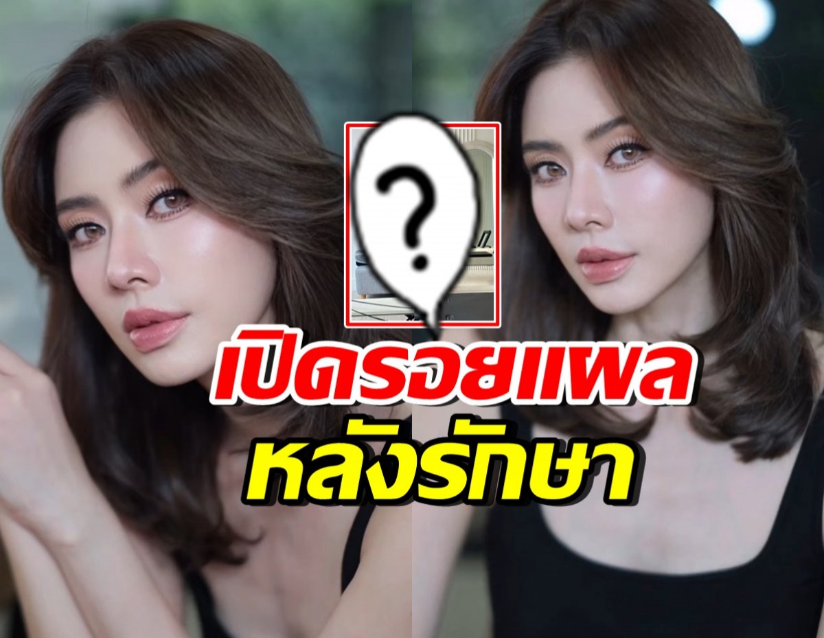 เปิดภาพล่าสุด เอ๋ พรทิพย์ เห็นรอยแผลชัด หลังผ่าตัดมะเร็ง