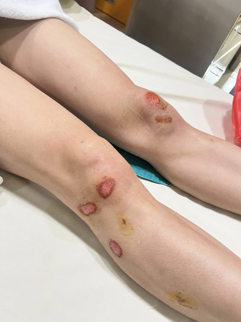 ตกใจทั้งถนน! ดาราดังประสบอุบัติเหตุ นั่งเจ็บเลือดเต็มตัว