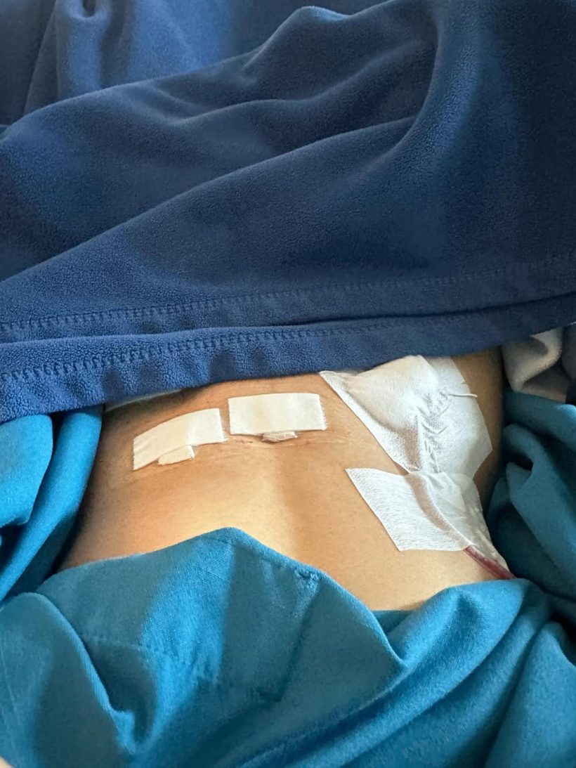 อุ้ม ทวีพร เล่าสาเหตุผ่าตัดด่วน คุณหมอยังถาม อดทนได้ยังไง!!