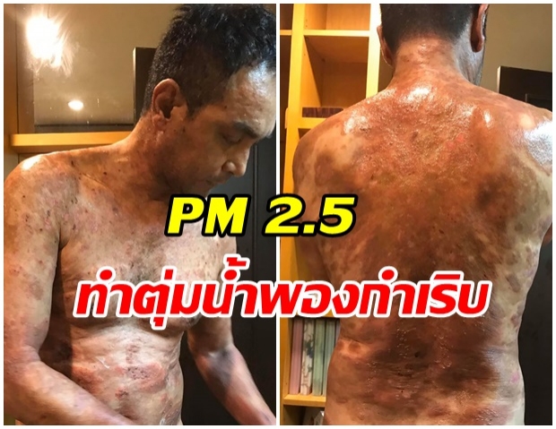 อากาศเเย่! เมฆ  วินัย  อาการกำเริบตุ่มขึ้นหนัก หลังวิกฤติ PM 2.5 