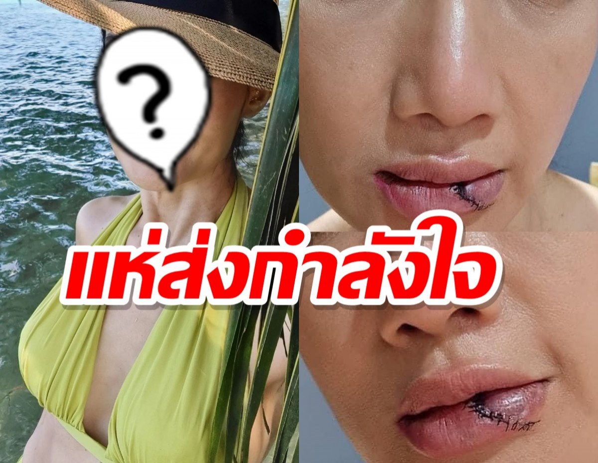 แห่ส่งกำลังใจดารารุ่นใหญ่เกิดอุบัติเหตุรถพัง-ปากฉีก