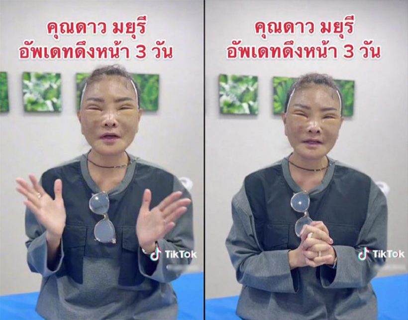  นักร้องสาวจ่อฟ้องคนบลูลี่หน้า เปิดสาเหตุศัลยกรรมสุดท้ายในชีวิต