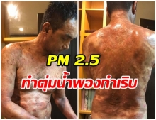 อากาศเเย่! เมฆ  วินัย  อาการกำเริบตุ่มขึ้นหนัก หลังวิกฤติ PM 2.5 