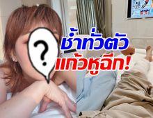 นักร้องสาว โพสต์พี่ชายเจอฝรั่งหัวร้อนทำร้าย ช้ำทั่วตัว แก้วหูฉีก!