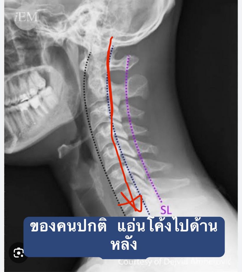 หมอดังเผยการเสียชีวิต ผิง ชญาดา อาจไม่ใช่จากการนวด