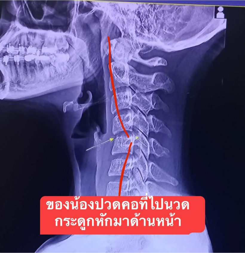 หมอดังเผยการเสียชีวิต ผิง ชญาดา อาจไม่ใช่จากการนวด