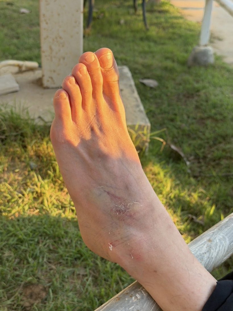 เเฟนๆส่งกำลังใจ ยูทูบเบอร์คนดัง ตกม้าบาดเจ็บหนัก