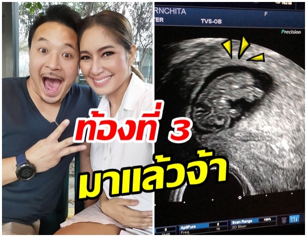 มิค-เบนซ์ เฮ!! เเจ้งข่าวดีท้องลูกคนที่ 3 เเล้วจ้า 