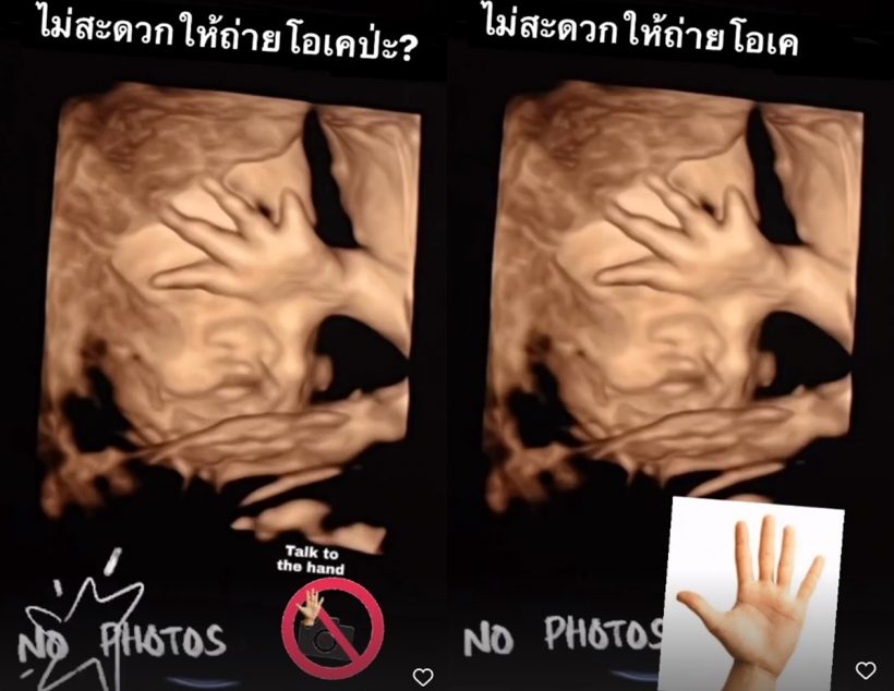 ว่าที่แม่ลูก3โชว์ภาพอัลตร้าซาวด์ หนูน้อยไม่โอเคแสบตั้งแต่ในท้อง