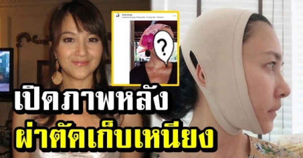 พึ่งมีดหมอครั้งแรก! เปิดภาพ “เข็ม ตีสิบ” หลังลงทุนผ่าตัดเก็บเหนียง ตอนนี้หน้าเรียวสวยแล้ว!