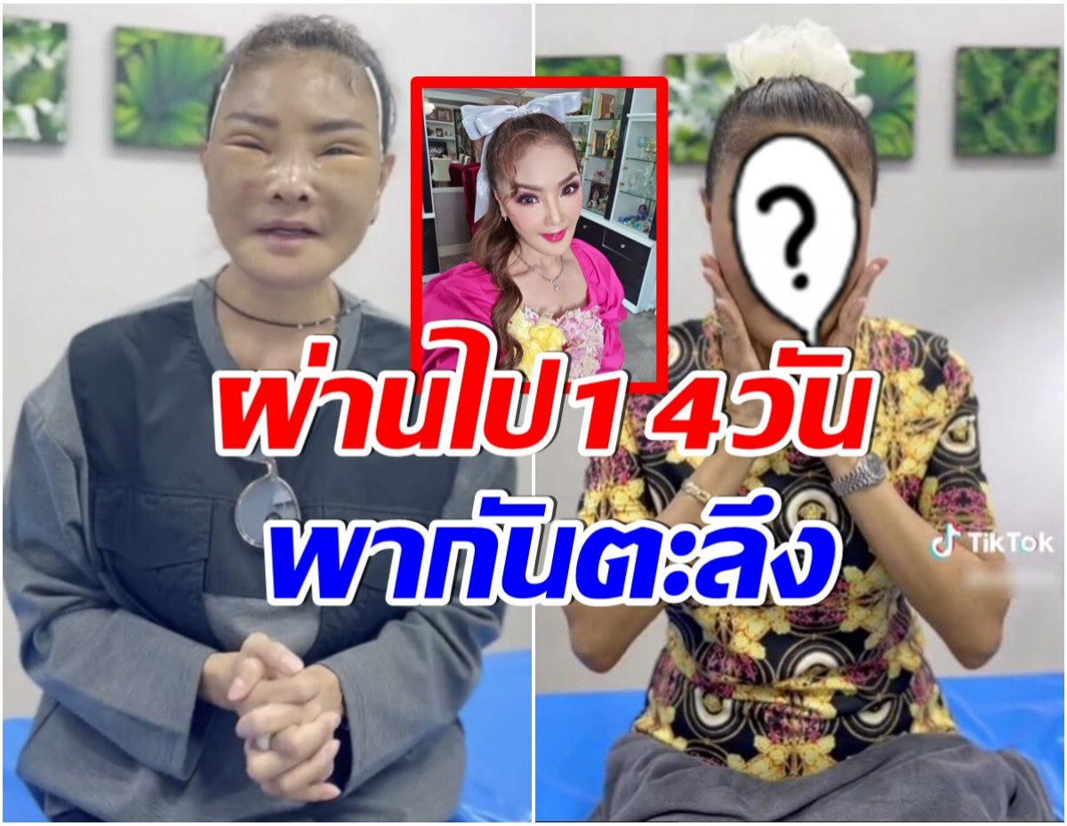 ตะลึงหน้าล่าสุด ดาว มยุรี ผ่านไป 14 วันเป็นเเบบนี้ไปเเล้ว