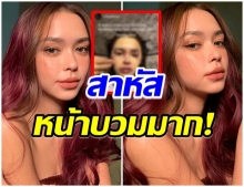 ตกใจทั้งไอจี!! เกิดอะไรขึ้นกับ เเพทริเซีย หน้าบวมช้ำ-เบ้าตาเขียว