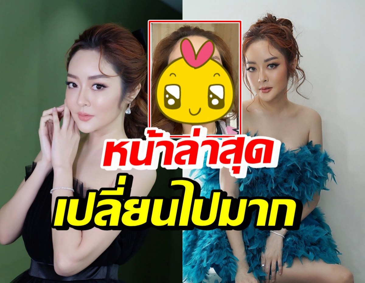  แก้มบุ๋ม โชว์ใบหน้าล่าสุดหลังเติมฟิลเลอร์ ลั่นต้องฉีดให้โลกรู้ไปเลย