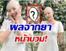 หน้าบวม! ภาพล่าสุด ออน พัชรวรรณ รองนางสาวไทย หลังป่วยมะเร็งต่อมน้ำเหลือง